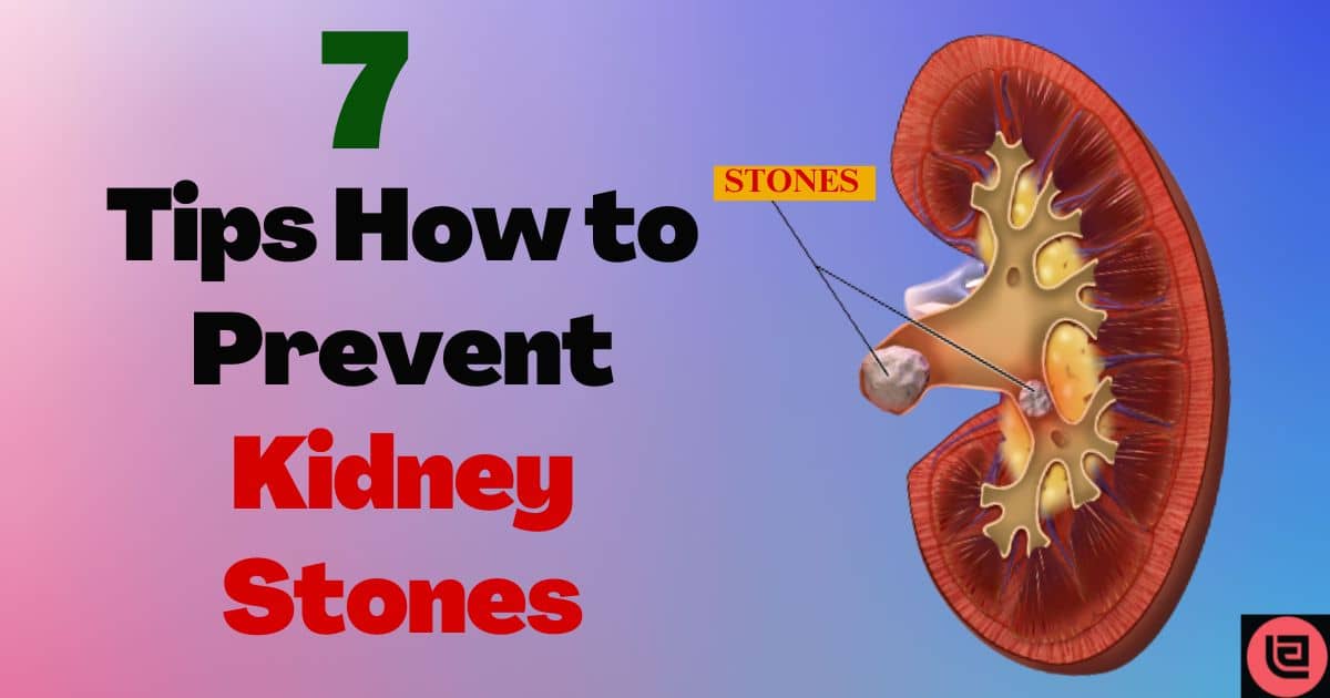 7 Tips How to Prevent Kidney Stones - Exclusive Web Stories